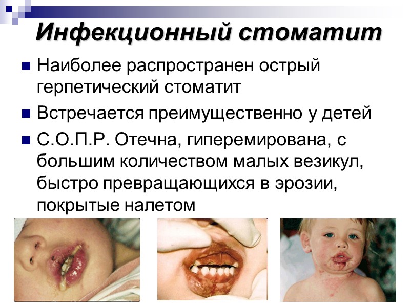 Инфекционный стоматит Наиболее распространен острый герпетический стоматит Встречается преимущественно у детей С.О.П.Р. Отечна, гиперемирована,